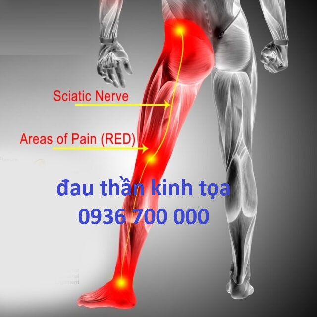 Đau thần kinh tọa (đau dây thần kinh hông to), thoát vị đĩa đệm