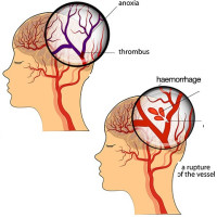Di chứng tai biến nhồi máu não, đột quỵ